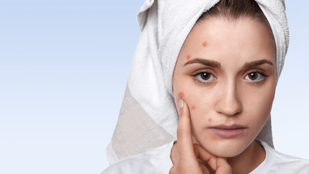 woman having pimples/Acne